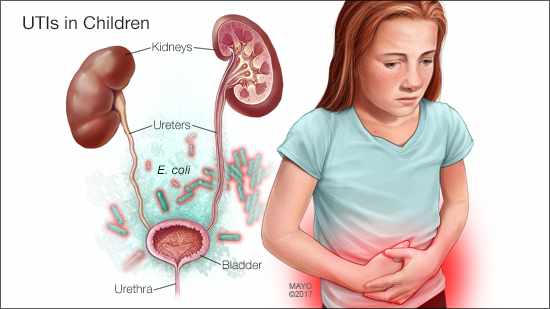 Urinary Tract Infections in Children – From the Triage Desk